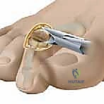 دمج مفصل إبهام القدم