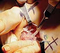 تثبيت العظام بشرائح التيتانيوم