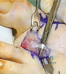 استئصال رؤوس مشط القدم