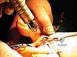 إعادة بناء مقدمة القدم الروماتويدية: دليل شامل للمرضى مع الأستاذ الدكتور محمد هطيف