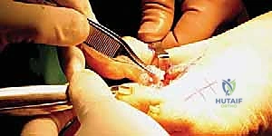 تشوهات القدم الروماتويدية المتقدمة