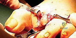 متابعة الالتئام بالأشعة السينية