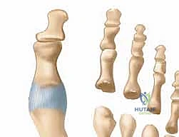 مسامير اللحم والتقرحات في باطن القدم