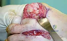 صورة قبل وبعد تصحيح التشوه