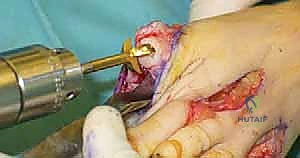 استعادة القدرة على المشي بثبات