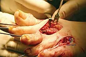 تثبيت الأصابع بالأسلاك المعدنية