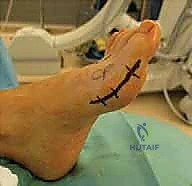 إزالة الأسلاك المعدنية في العيادة