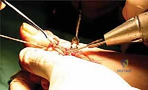 رفع القدم لتقليل التورم