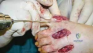 صورة توضيحية لـ إعادة بناء مقدمة القدم الروماتويدية: دليل شامل للمرضى مع الأستاذ الدكتور محمد هطيف