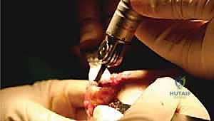 بروتوكول إدارة الألم بعد الجراحة