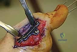 صورة توضيحية لـ إعادة بناء مقدمة القدم الروماتويدية: دليل شامل للمرضى مع الأستاذ الدكتور محمد هطيف