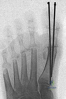صورة توضيحية لـ إعادة بناء مقدمة القدم الروماتويدية: دليل شامل للمرضى مع الأستاذ الدكتور محمد هطيف