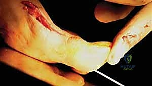 شكل القدم الطبيعي بعد التعافي التام