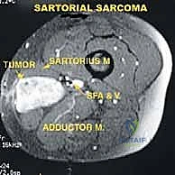 Sartorial Canal Tumor Resection: An Intraoperative Masterclass in Limb Salvage