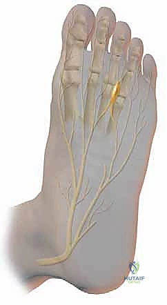 Mastering Morton's Neuroma Excision: A Comprehensive Intraoperative Guide