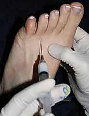 ورم مورتون العصبي: دليل شامل للتشخيص والعلاج المتقدم على يد الأستاذ الدكتور محمد هطيف في صنعاء