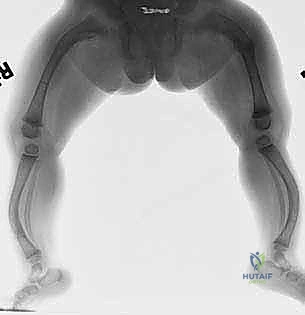 تشوهات العظام الطويلة في الفخذ والقصبة