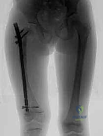 تصوير شعاعي يوضح شدة الكسور في العظام الزجاجية