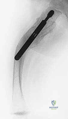 الأساس الجيني لمرض تخلّق العظم الناقص