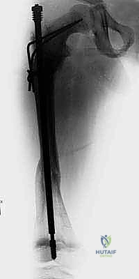 صورة توضيحية لـ علاج تشوهات العظام الطويلة لدى الأطفال المصابين بتخلّق العظم الناقص: تقنية بضع العظم عبر الجلد والمسامير التلسكوبية (فاسييه-دوفال)