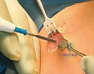 مزايا استخدام المسامير التلسكوبية في جراحة الأطفال