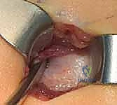 تصميم المسمار التلسكوبي Fassier-Duval