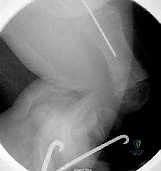 استخدام جهاز C-arm أثناء الجراحة