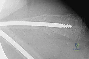 إدخال السلك الدليلي في العظم المقوم