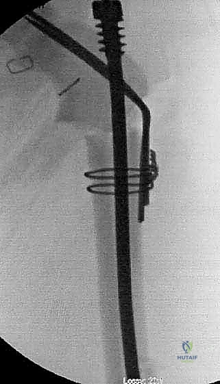 صورة أشعة توضح استقامة ساقي الطفل عمار