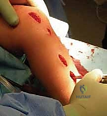 العلاج المائي واستعادة القدرة على المشي