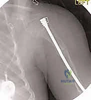 آلية عمل المسمار التلسكوبي مع نمو العظم