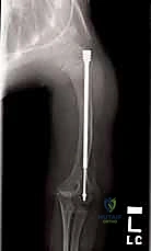 صورة توضيحية لـ علاج تشوهات العظام الطويلة لدى الأطفال المصابين بتخلّق العظم الناقص: تقنية بضع العظم عبر الجلد والمسامير التلسكوبية (فاسييه-دوفال)