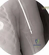 متابعة حالة المسمار التلسكوبي على المدى الطويل