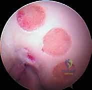 Osteochondral Autograft Plug Transfer: A Masterclass in Articular Cartilage Restoration