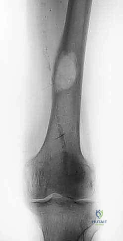 Masterclass: Surgical Management of Femoral Metastatic Bone Disease – Proximal and Diaphyseal Lesions