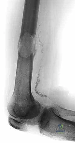 الأورام الأولية الشائعة