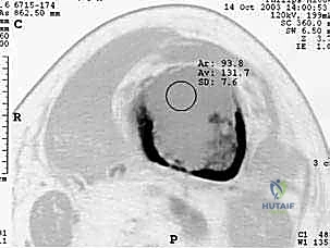 آلية انتقال الخلايا السرطانية للعظم