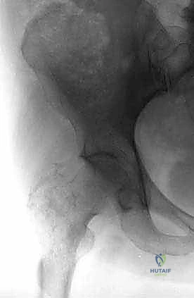 تأثير الورم على القشرة العظمية