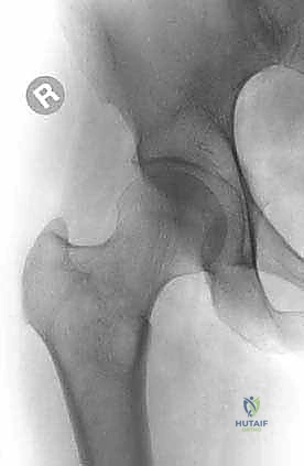 النقائل العظمية في الفخذ