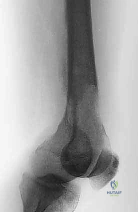 الأشعة السينية لنقائل الفخذ