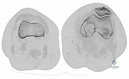 تشريح الركبة والجزء السفلي للفخذ