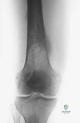 توزيع العضلات حول عظم الفخذ