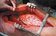 أخذ خزعة من الورم العظمي