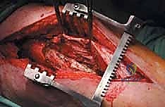 إدارة نقائل العظم الفخذي جراحياً: دليل شامل للمرضى مع الأستاذ الدكتور محمد هطيف في صنعاء