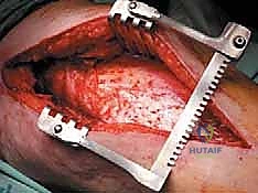 تقييم هشاشة القشرة العظمية