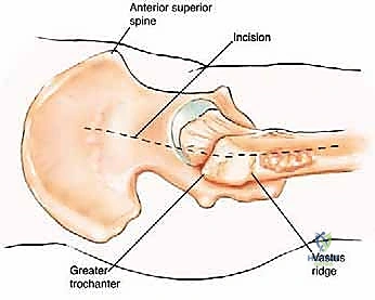 صورة الرنين المغناطيسي للورم