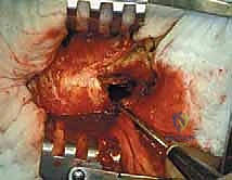 صورة توضيحية لـ إدارة نقائل العظم الفخذي جراحياً: دليل شامل للمرضى مع الأستاذ الدكتور محمد هطيف في صنعاء