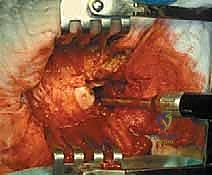 صورة توضيحية لـ إدارة نقائل العظم الفخذي جراحياً: دليل شامل للمرضى مع الأستاذ الدكتور محمد هطيف في صنعاء