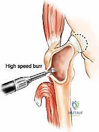 صورة توضيحية لـ إدارة نقائل العظم الفخذي جراحياً: دليل شامل للمرضى مع الأستاذ الدكتور محمد هطيف في صنعاء