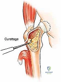 صورة توضيحية لـ إدارة نقائل العظم الفخذي جراحياً: دليل شامل للمرضى مع الأستاذ الدكتور محمد هطيف في صنعاء